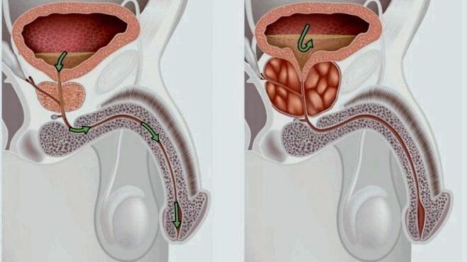 zdrava in vneta prostata s prostatitisom