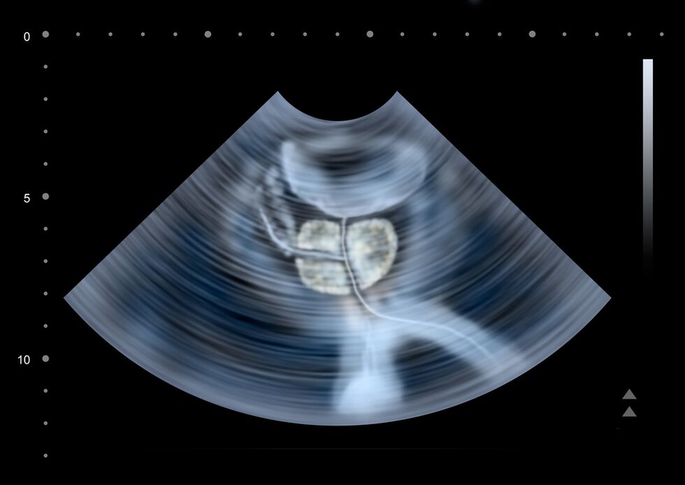 diagnostika prostate