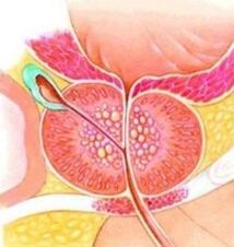Prostata adenom