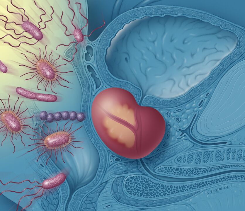 Prostatitis pri moških