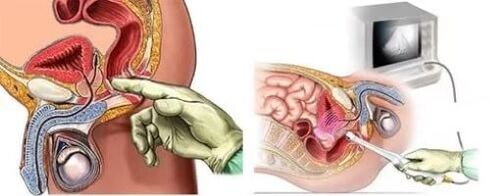 Instrumentalna diagnoza prostatitisa